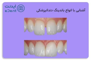 انواع باندینگ شامل هشت نسل است که هر کدام ویژگی خاص خود را دارند.