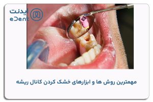 مهمترین روش ها و ابزارهای خشک کردن کانال ریشه در دندانپزشکی