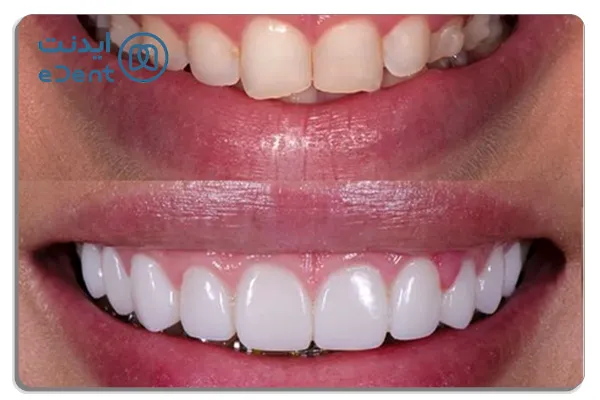 تفاوت کامپوزیت کاریزما و سارمکو از نظر فناوری