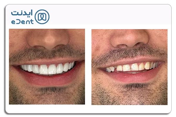 مقایسه کاربرد کامپوزیت کاریزما و سارمکو