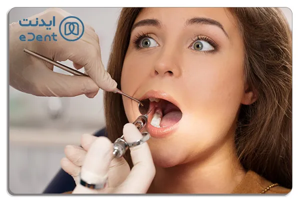 تجهیزات و ابزارهای اولیه برای شروع درمان در عصب کشی دندان