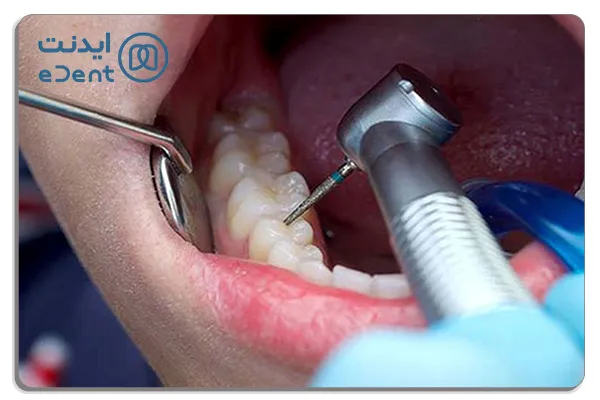 وسایل عصب کشی دندان