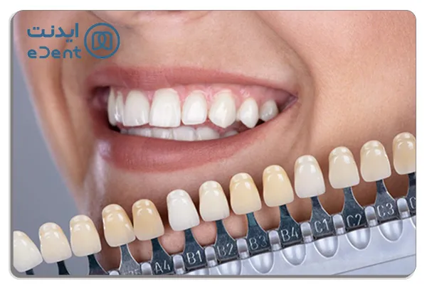 انتخاب رنگ کامپوزیت در راهنمای خرید کامپوزیت